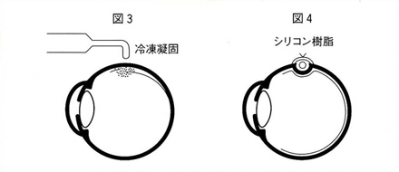 目とメガネに関する豆知識